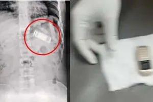 जेल में बंद कैदी का X-Ray देख मचा हड़कंप, पेट में दिखा मोबाइल, डाक्टरों ने ऐसे बचाई जान